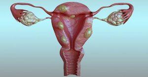 Uterine fibroids (1)