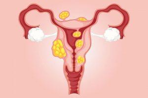 Uterine fibroids (2)