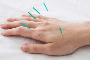 Acupuncture (1)