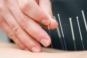 Acupuncture (2)