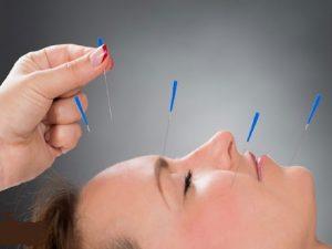 Acupuncture (3)