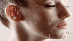 Acupuncture (4)