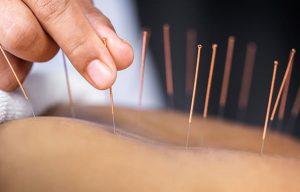 Acupuncture (5)