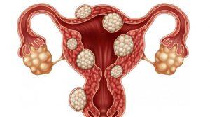 Uterine fibroids (5)