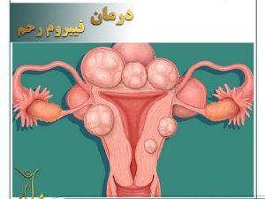 Uterine fibroids (3)