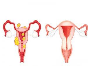 Uterine fibroids (4)