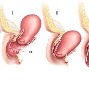 Uterine prolapse (1)
