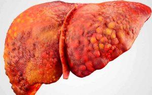 Fatty Liver (7)