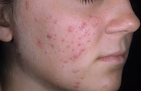 acne (1)