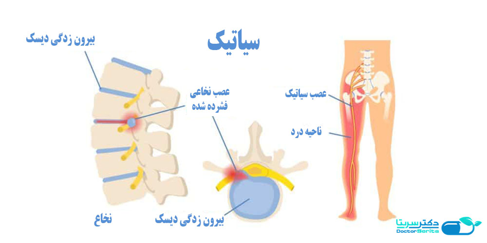 عصب سیاتیک و ناحیه درد در ران و ساق پا و ماساژ سیاتیک