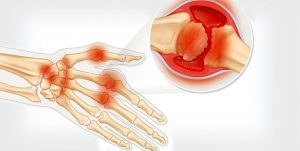 Joint pain (3)