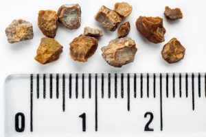 kidney stone (2)