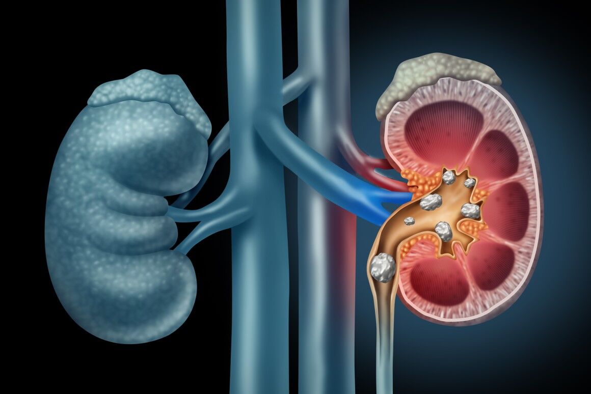 kidney stone (4)